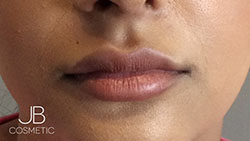 Discover Lip Fillers Cardiff: 