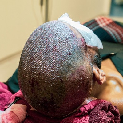 Is Hair Transplant Permissible in Islam?: 