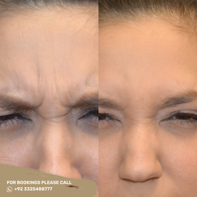 Top 5 benefits of Botox injections: 