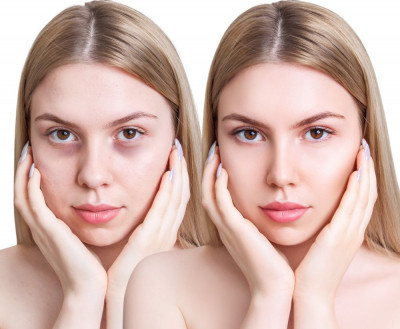 mesotherapy for dark circles cost in islamabad: 
