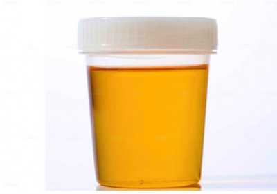 Nước tiểu màu cam ở phụ nữ có nguy hiểm không?: 