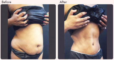 Tummy Tuck Recovery Time – The Complete Guide: 