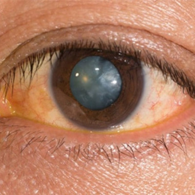 Experience Clear Vision with LASIK Eye Surgery at Harley Vision: 