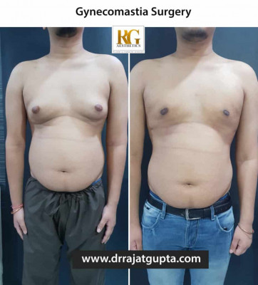 Top 5 Benefits of Gynecomastia Surgery for Men: 