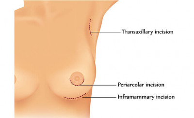 Choosing the Right Surgeon for Breast Augmentation: 