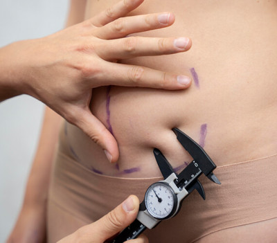 Tummy Tuck Surgery in Delhi by Dr. Lokesh Handa: 