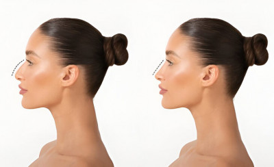 Who is the Best Rhinoplasty Surgeon in India?: 