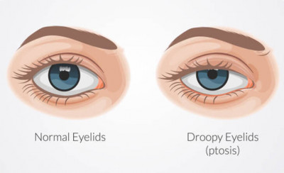 Comprehensive Guide to Eyelid Surgery in Delhi with Dr. Lokesh Handa: 