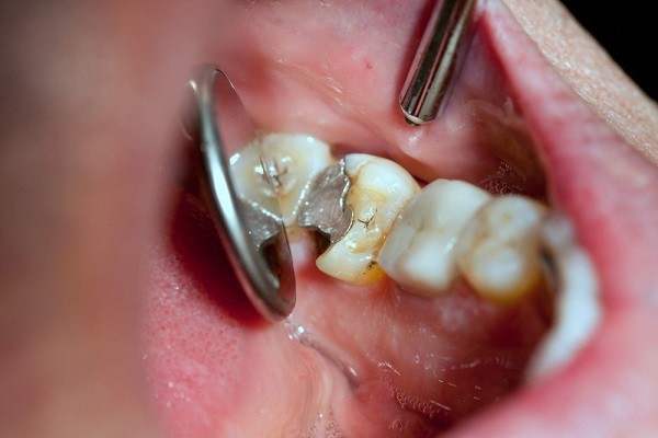 Tooth Extractions Christchurch