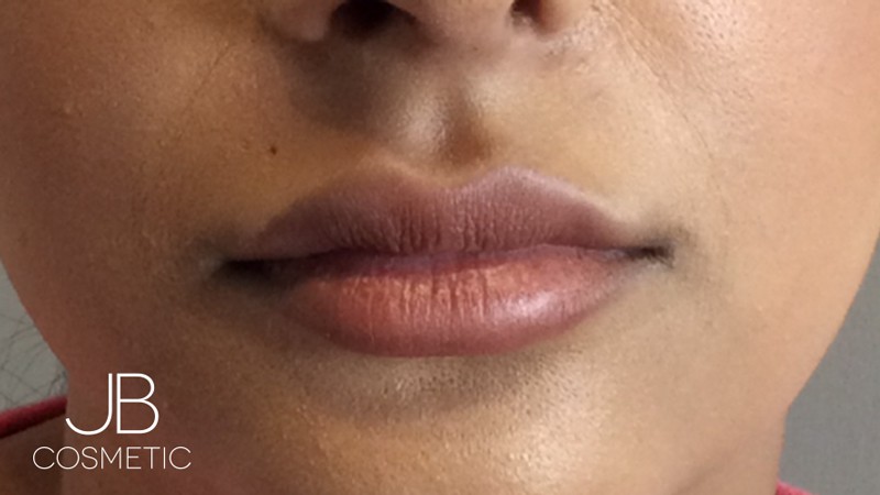 Discover Lip Fillers Cardiff