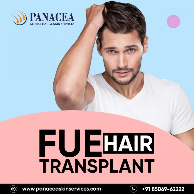 FUE Hair Transplant in New Delhi: 