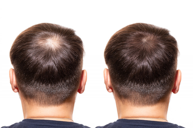 Hair Transplant and Cultural Perceptions of Beauty: 