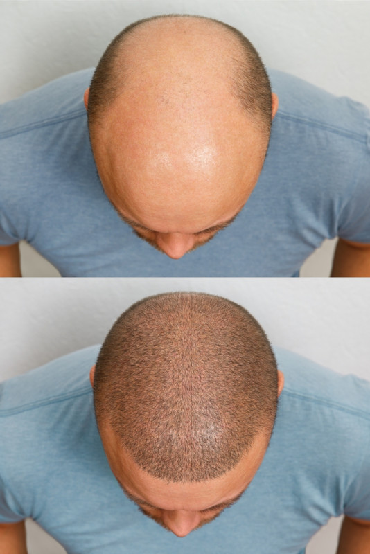 Hair Transplant Financing: Options for Affording the Procedure: 