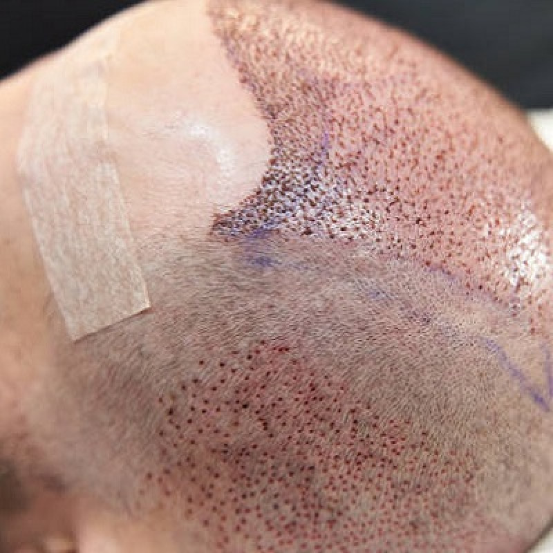 Are the results of hair transplant permanent?: 