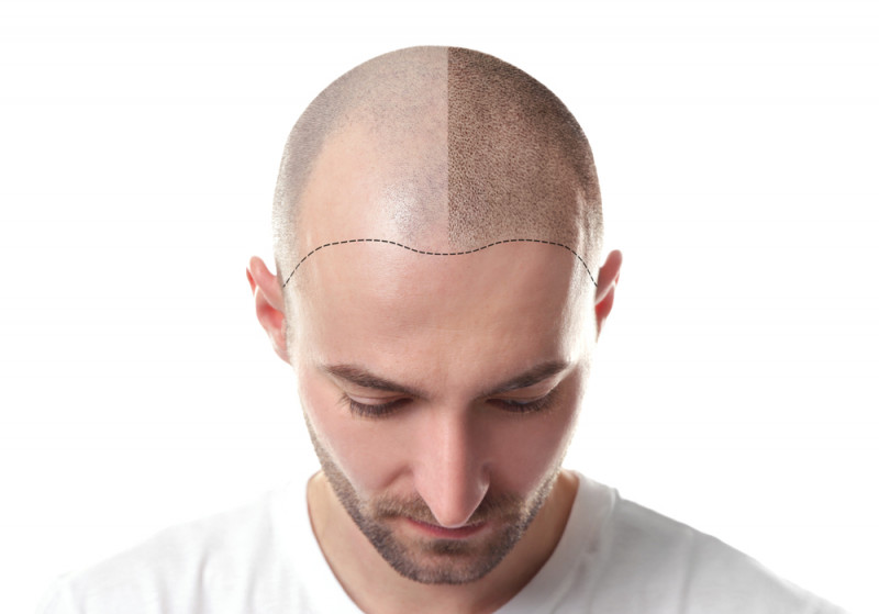 Is it Expensive to Get a Hair Transplant?: 