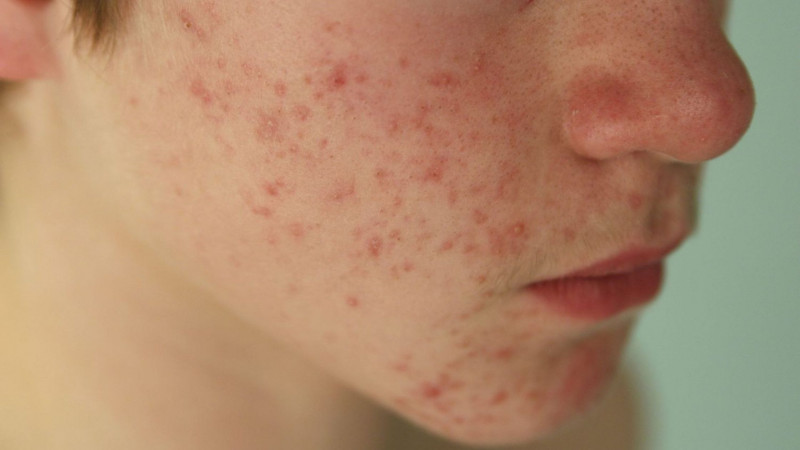 How Homeopathy Helps In Treating Skin Conditions like Melasma and Fungal Infections: 