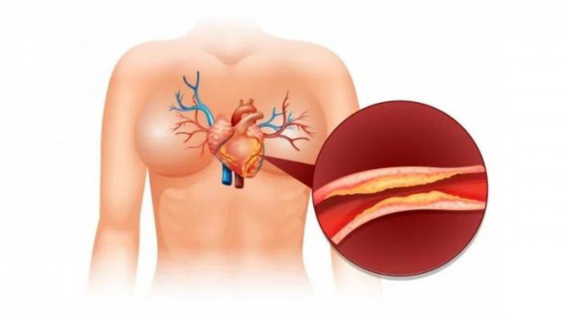 Homeopathy Medicine For Cholesterol | Homoeobazaar