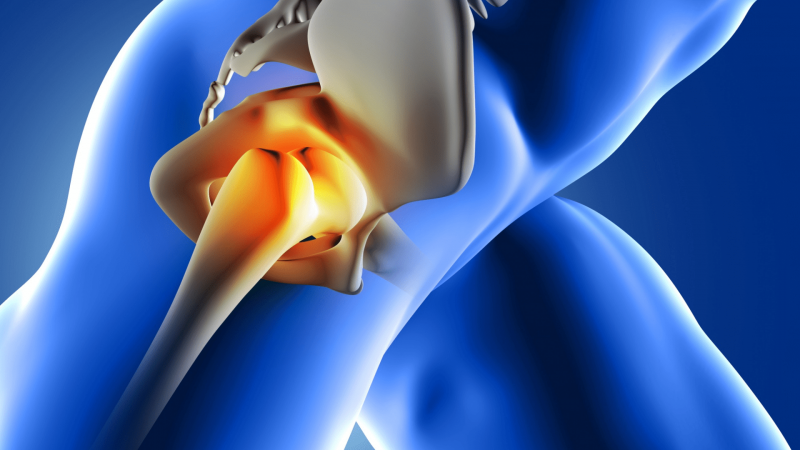 Hip Replacement Surgery In India