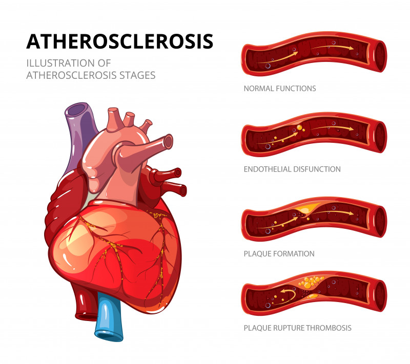Coronary Artery Bypass Surgery Cost In India
