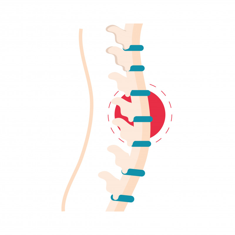Spinal Cord Tumor Treatment In India