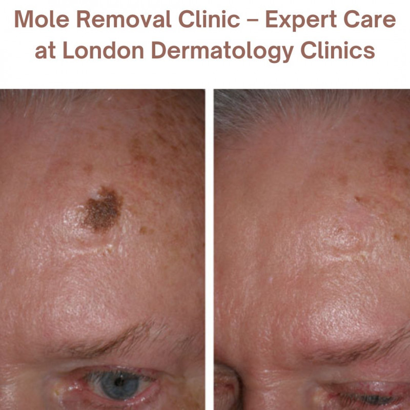 Professional Mole Removal in London - London Dermatology Clinics