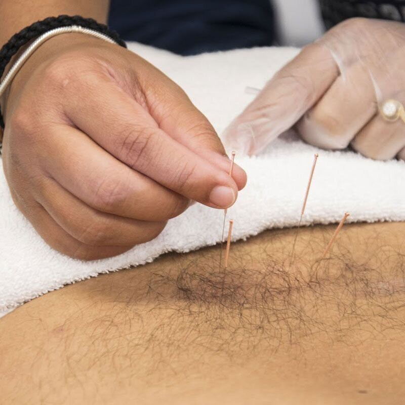 dry needling ims: 