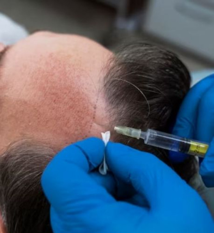 Body Hair Transplant in Delhi: 