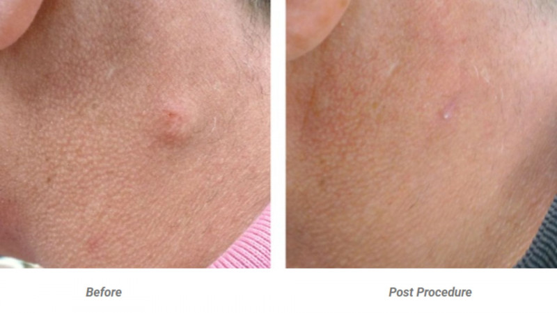 Expert Cyst Removal in London | London Dermatology Clinics: 