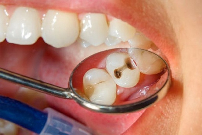 Giải đáp thắc mắc về trám răng hàn răng: 
