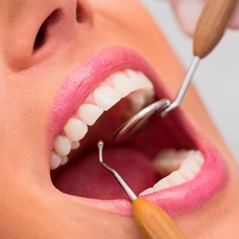 What Is a Root Canal? Everything You Need to Know: 