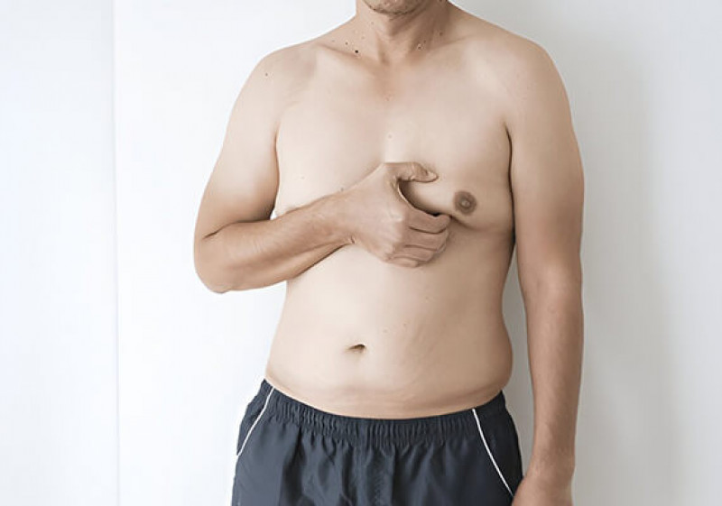 Gynecomastia Surgery in Delhi - Dr. Lokesh Handa: 