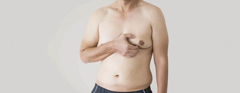 Gynecomastia Recurrence: Is It A Real Concern - Dr. Lokesh Handa: 