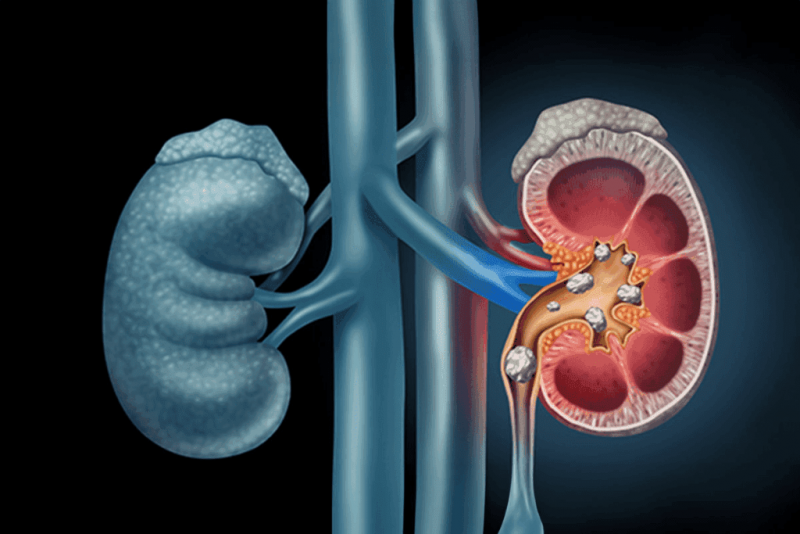 Best Herbs for Kidney Stones – Natural Relief with Medilux Ayurveda: 