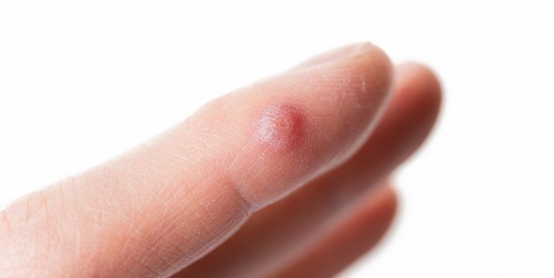 Dermatologist Wart Removal – Safe & Professional Treatment at London Dermatology Clinic: 